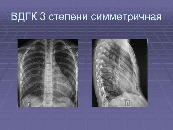 ВДГК 3 степени симметричная 