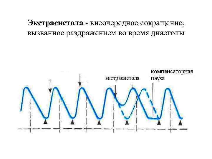 Экстрасистола - внеочередное сокращение, вызванное раздражением во время диастолы 