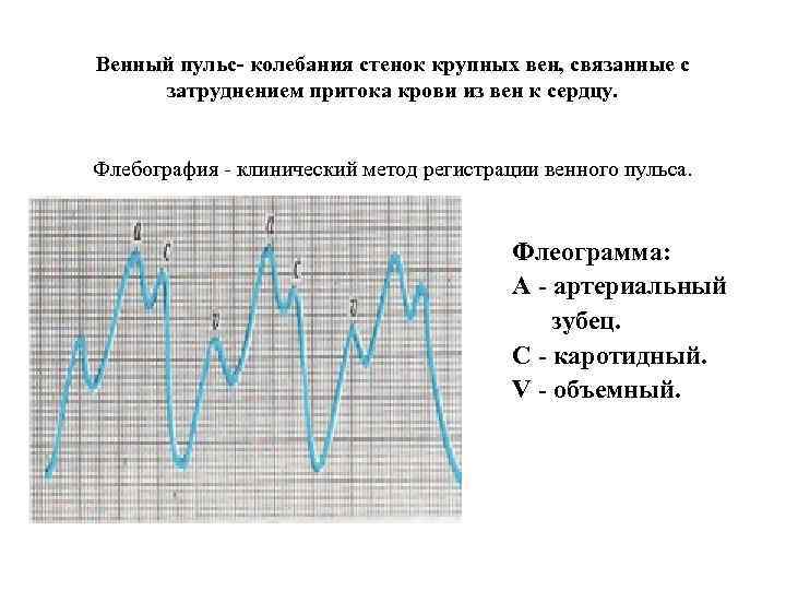 Венный пульс- колебания стенок крупных вен, связанные с затруднением притока крови из вен к