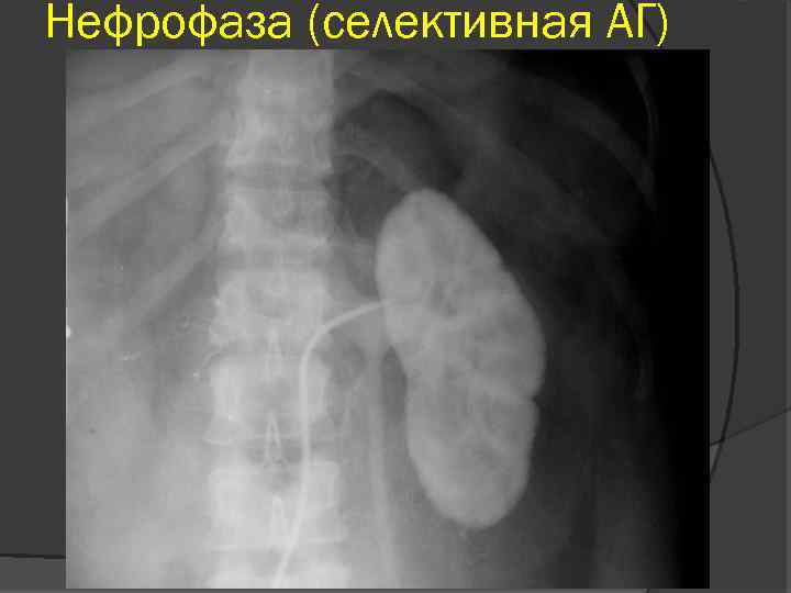 Нефрофаза (селективная АГ) 