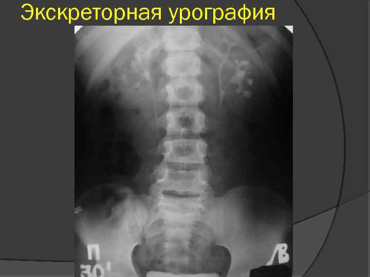 Экскреторная урография 