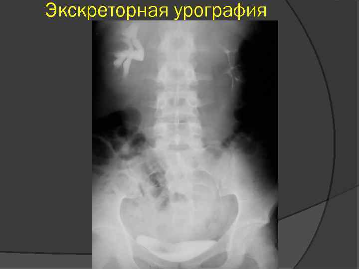 Экскреторная урография 