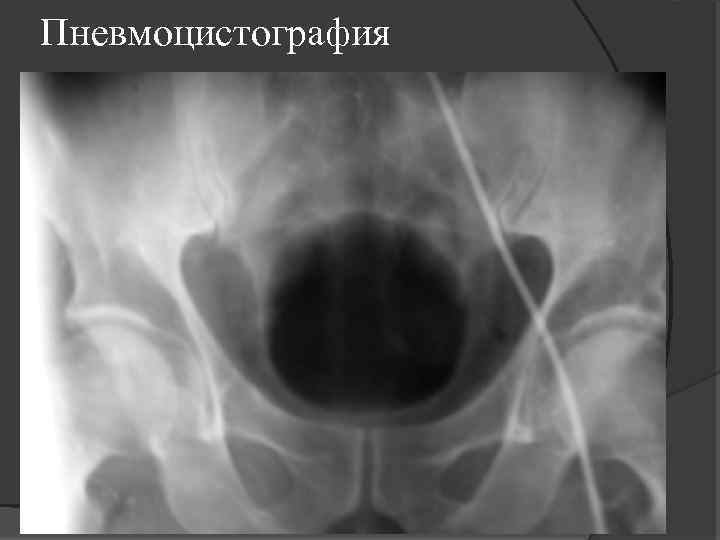 Пневмоцистография 