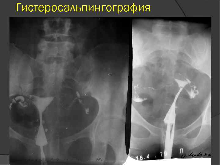 Гистеросальпингография 