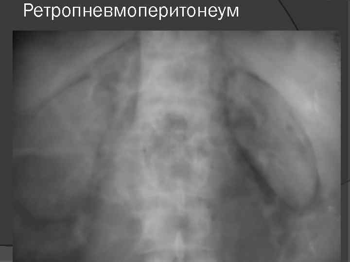 Ретропневмоперитонеум 