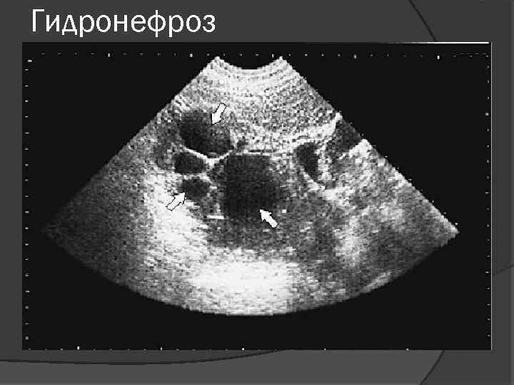 Гидронефроз 