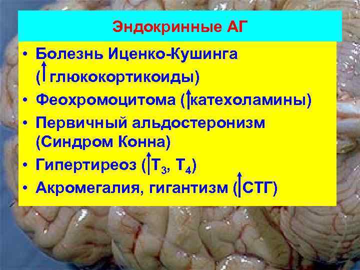 Эндокринные АГ • Болезнь Иценко-Кушинга ( глюкокортикоиды) • Феохромоцитома ( катехоламины) • Первичный альдостеронизм