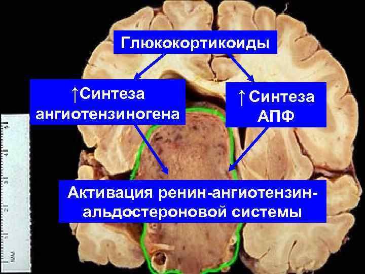 Глюкокортикоиды ↑Синтеза ангиотензиногена ↑ Синтеза АПФ Активация ренин-ангиотензинальдостероновой системы 