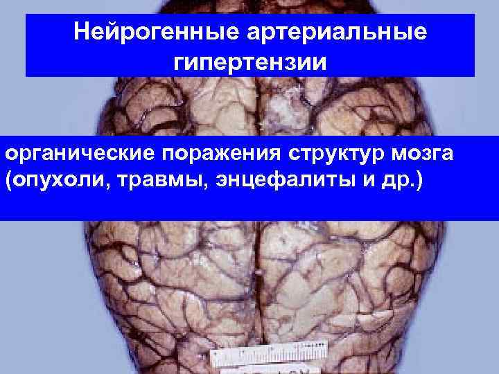 Нейрогенные артериальные гипертензии органические поражения структур мозга (опухоли, травмы, энцефалиты и др. ) 