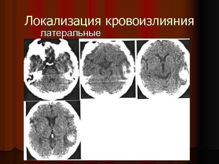 Локализация кровоизлияния латеральные 