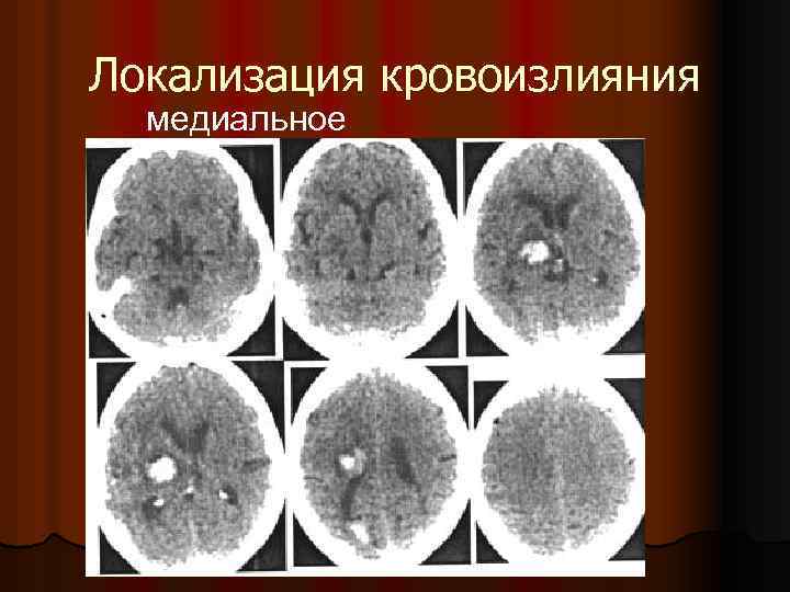 Локализация кровоизлияния медиальное 