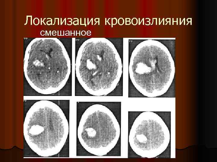 Локализация кровоизлияния смешанное 