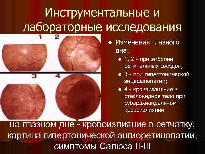 Инструментальные и лабораторные исследования l Изменения глазного дна: 1, 2 - при эмболии ретинальных