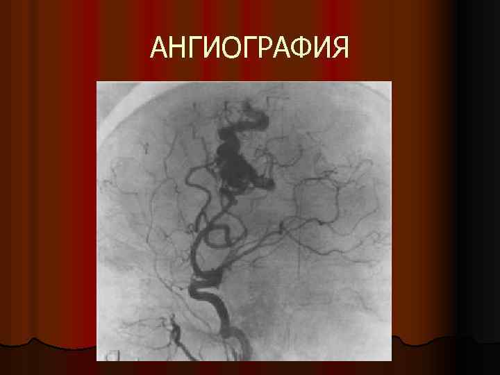 АНГИОГРАФИЯ 