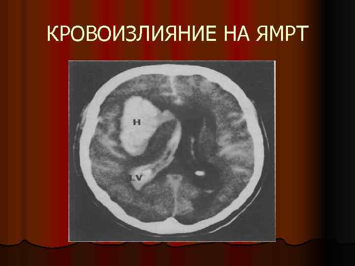 КРОВОИЗЛИЯНИЕ НА ЯМРТ 