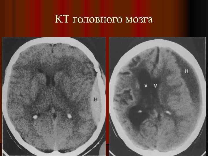 КТ головного мозга 