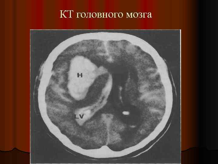 КТ головного мозга 