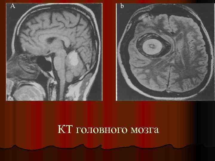 A b КТ головного мозга 