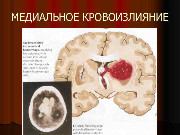 МЕДИАЛЬНОЕ КРОВОИЗЛИЯНИЕ 