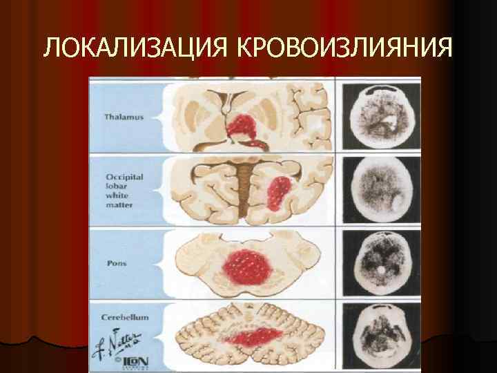 ЛОКАЛИЗАЦИЯ КРОВОИЗЛИЯНИЯ 