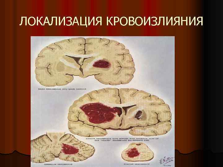 ЛОКАЛИЗАЦИЯ КРОВОИЗЛИЯНИЯ 