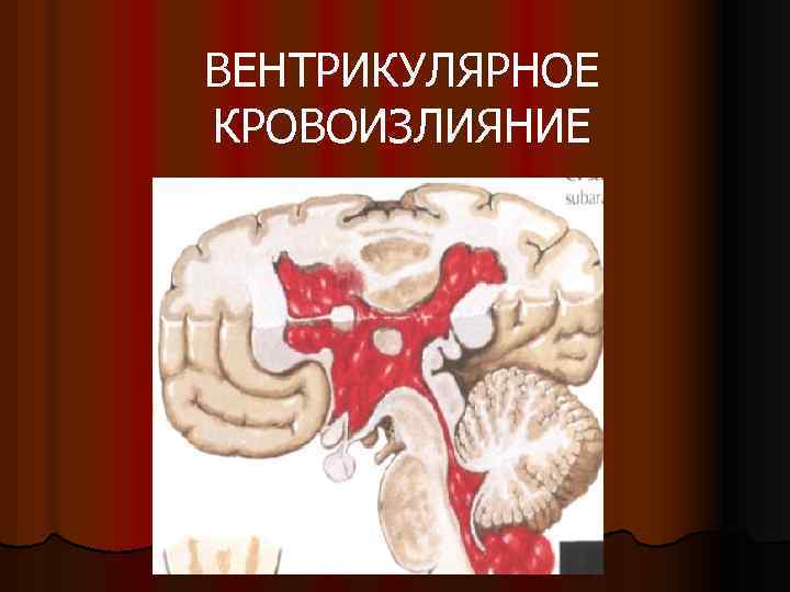 ВЕНТРИКУЛЯРНОЕ КРОВОИЗЛИЯНИЕ 