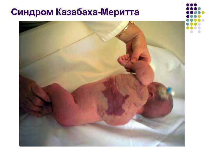 Синдром Казабаха-Меритта 