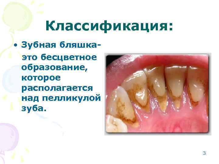 Классификация: • Зубная бляшкаэто бесцветное образование, которое располагается над пелликулой зуба. 3 