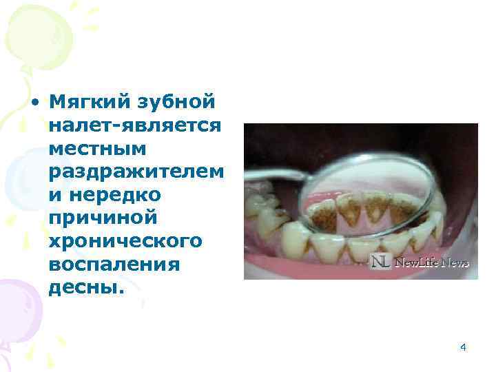  • Мягкий зубной налет-является местным раздражителем и нередко причиной хронического воспаления десны. 4