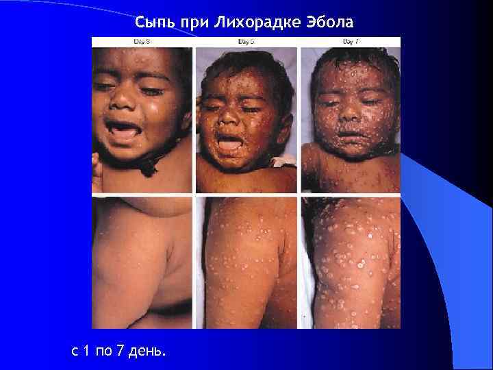 Сыпь при Лихорадке Эбола с 1 по 7 день. 