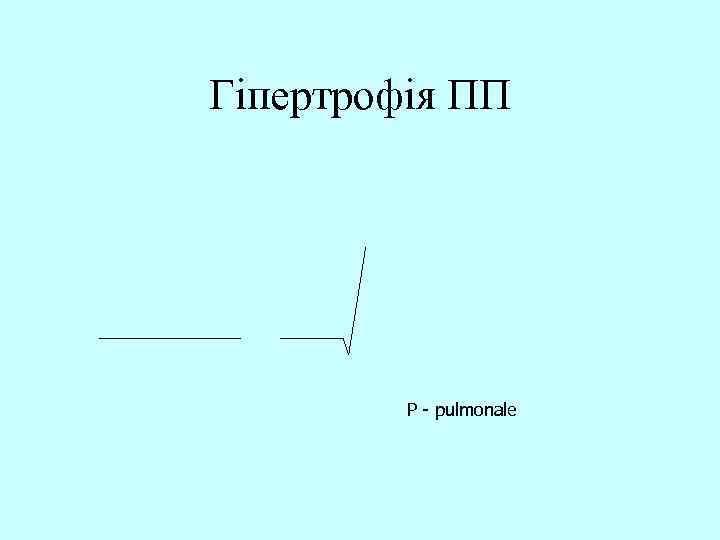 Гіпертрофія ПП Р - pulmonale 