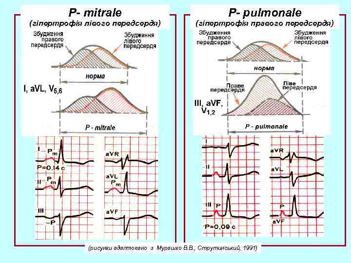 P- mitrale (гіпертрофія лівого передсердя) P- pulmonale (гіпертрофія правого передсердя) (рисунки адаптовано з Мурашко