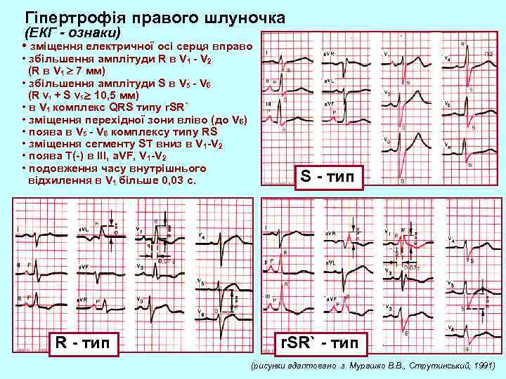 Гіпертрофія правого шлуночка (ЕКГ - ознаки) • зміщення електричної осі серця вправо • збільшення