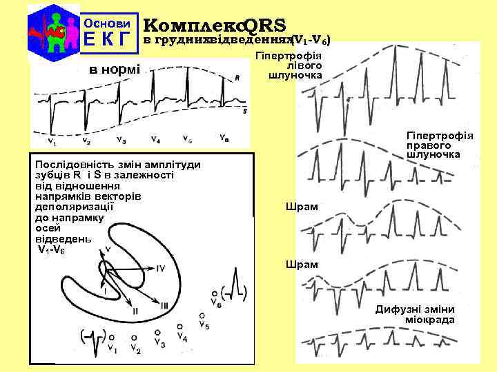 Основи ЕКГ Комплекс QRS в груднихвідведеннях 1 -V 6) (V в нормі Послідовність змін