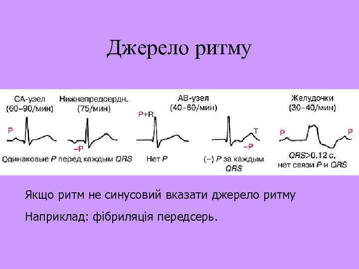 Джерело ритму Якщо ритм не синусовий вказати джерело ритму Наприклад: фібриляція передсерь. 