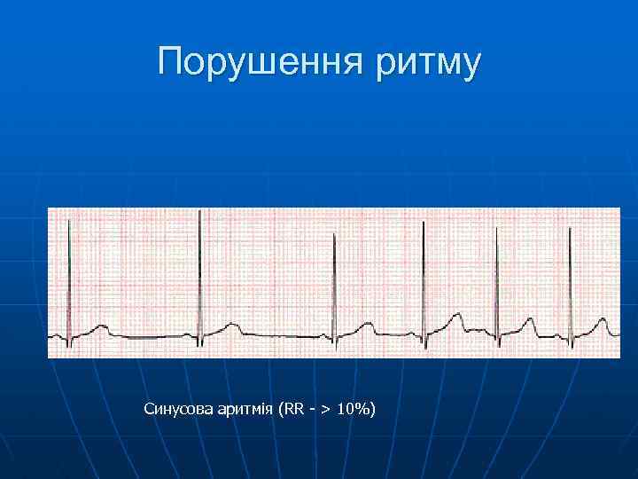 Порушення ритму Синусова аритмія (RR - > 10%) 