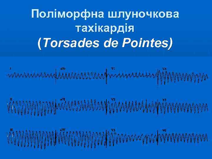 Поліморфна шлуночкова тахікардія (Torsades de Pointes) 