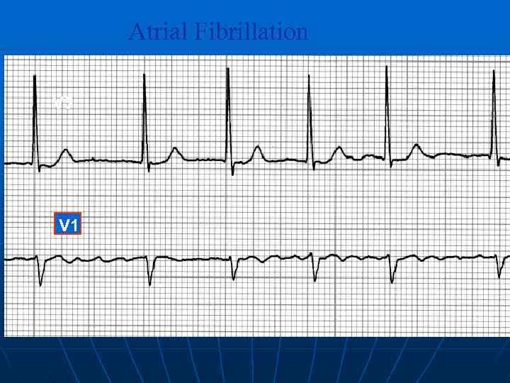 Atrial Fibrillation V 5 V 1 