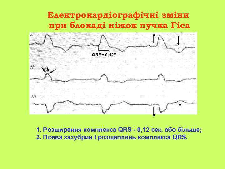 Електрокардіографічні зміни при блокаді ніжок пучка Гіса QRS= 0, 12