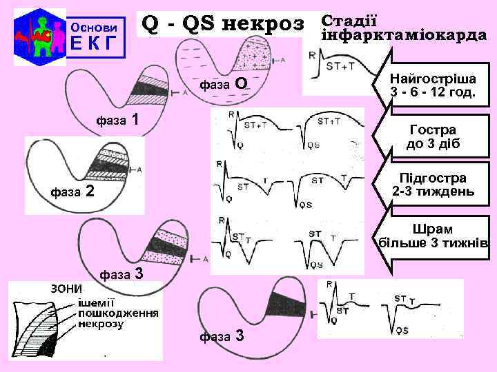 Q - QS некроз Основи ЕКГ фаза О 1 Стадії інфаркта міокарда Найгостріша 3