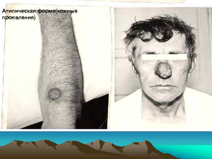 Атипическая форма(кожные проявления) 