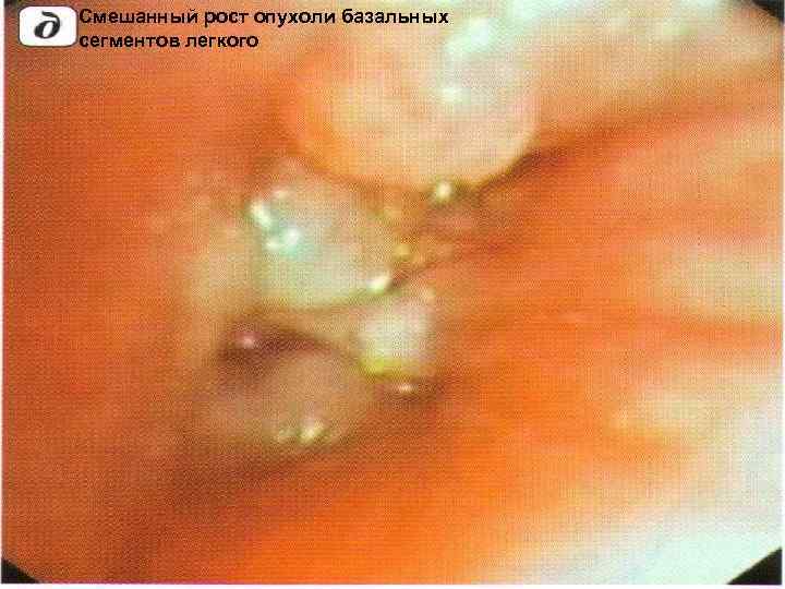 Смешанный рост опухоли базальных сегментов легкого 