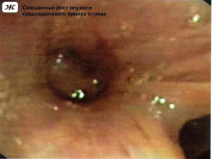 Смешанный рост опухоли среднедолевого бронха справа 