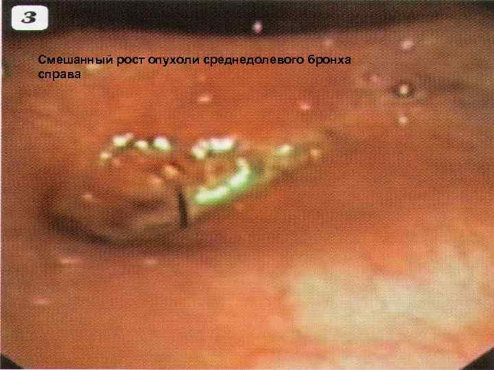 Смешанный рост опухоли среднедолевого бронха справа 