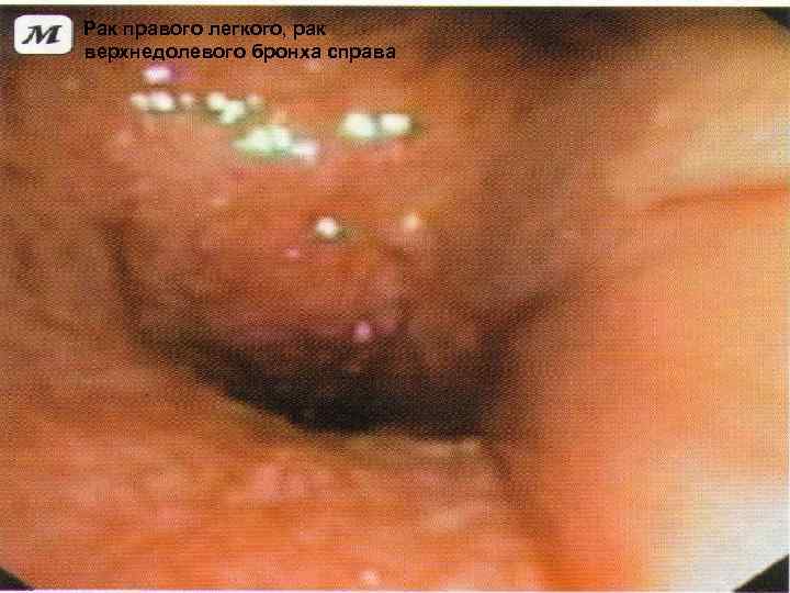 Рак правого легкого, рак верхнедолевого бронха справа 