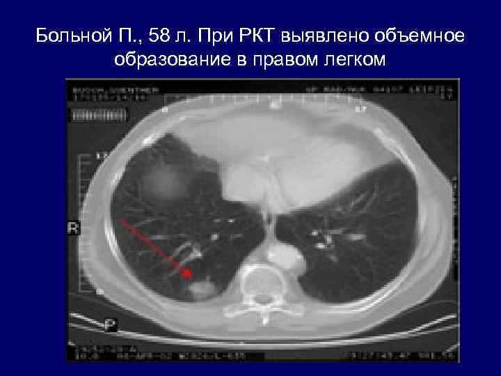Больной П. , 58 л. При РКТ выявлено объемное образование в правом легком 
