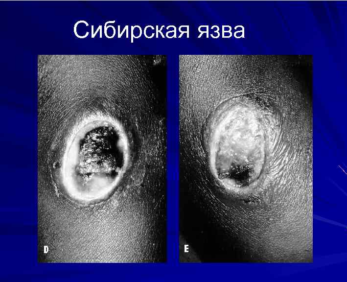 Сибирская язва 