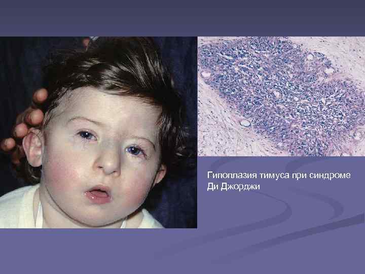 n Гипоплазия тимуса при синдроме Ди Джорджи 