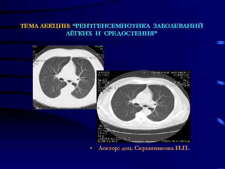 ТЕМА ЛЕКЦИИ: “РЕНТГЕНСЕМИОТИКА ЗАБОЛЕВАНИЙ  ЛЁГКИХ И СРЕДОСТЕНИЯ”     • Лектор: