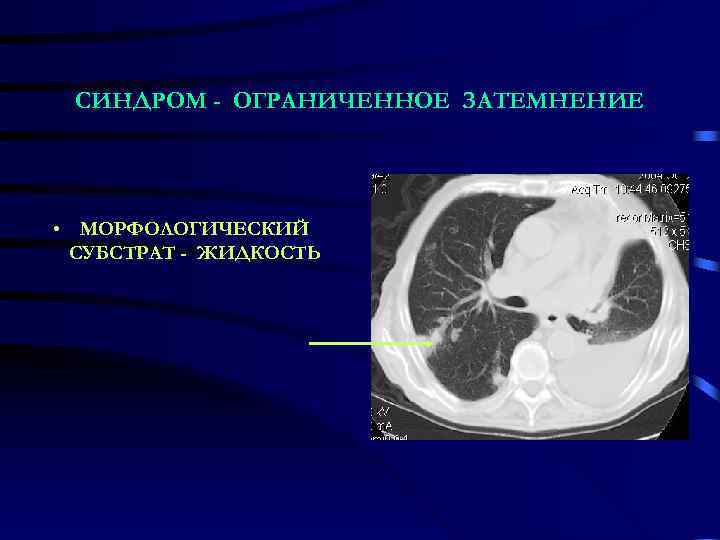  СИНДРОМ - ОГРАНИЧЕННОЕ ЗАТЕМНЕНИЕ • МОРФОЛОГИЧЕСКИЙ СУБСТРАТ - ЖИДКОСТЬ 